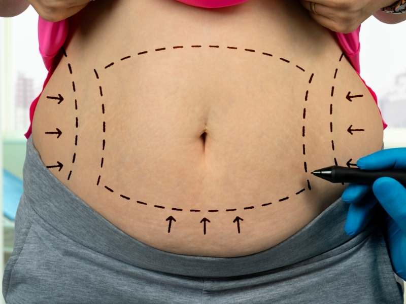 liposuction-nedir